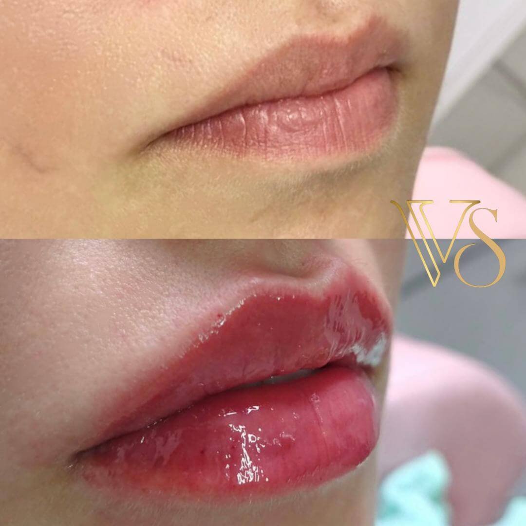 Referencia em preenchimento labial em Castro e Ponta Grossa - Dra Vanessa Silveira injetáveis de alta performance.