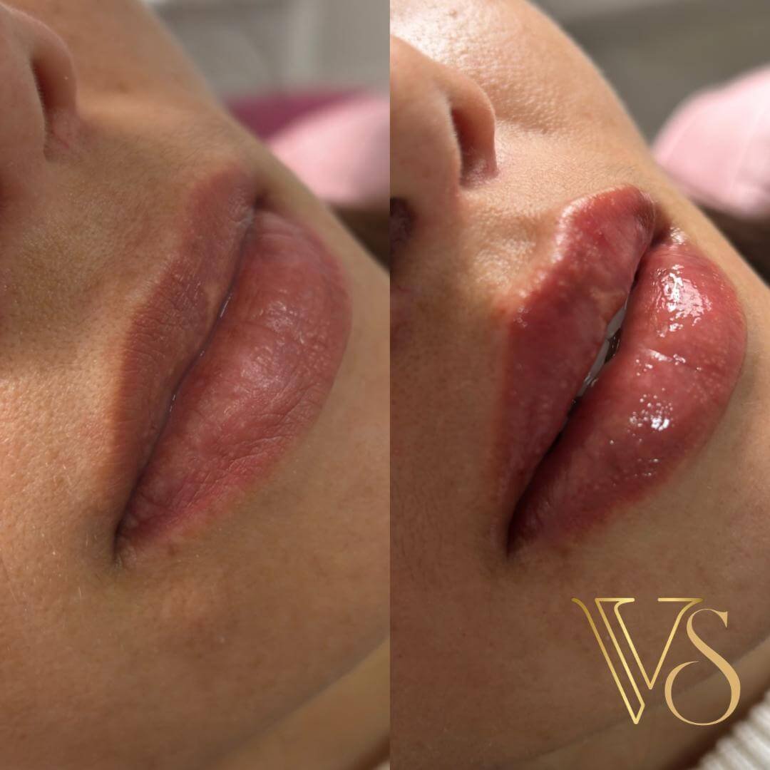 Referencia em preenchimento labial em Castro e Ponta Grossa - Dra Vanessa Silveira