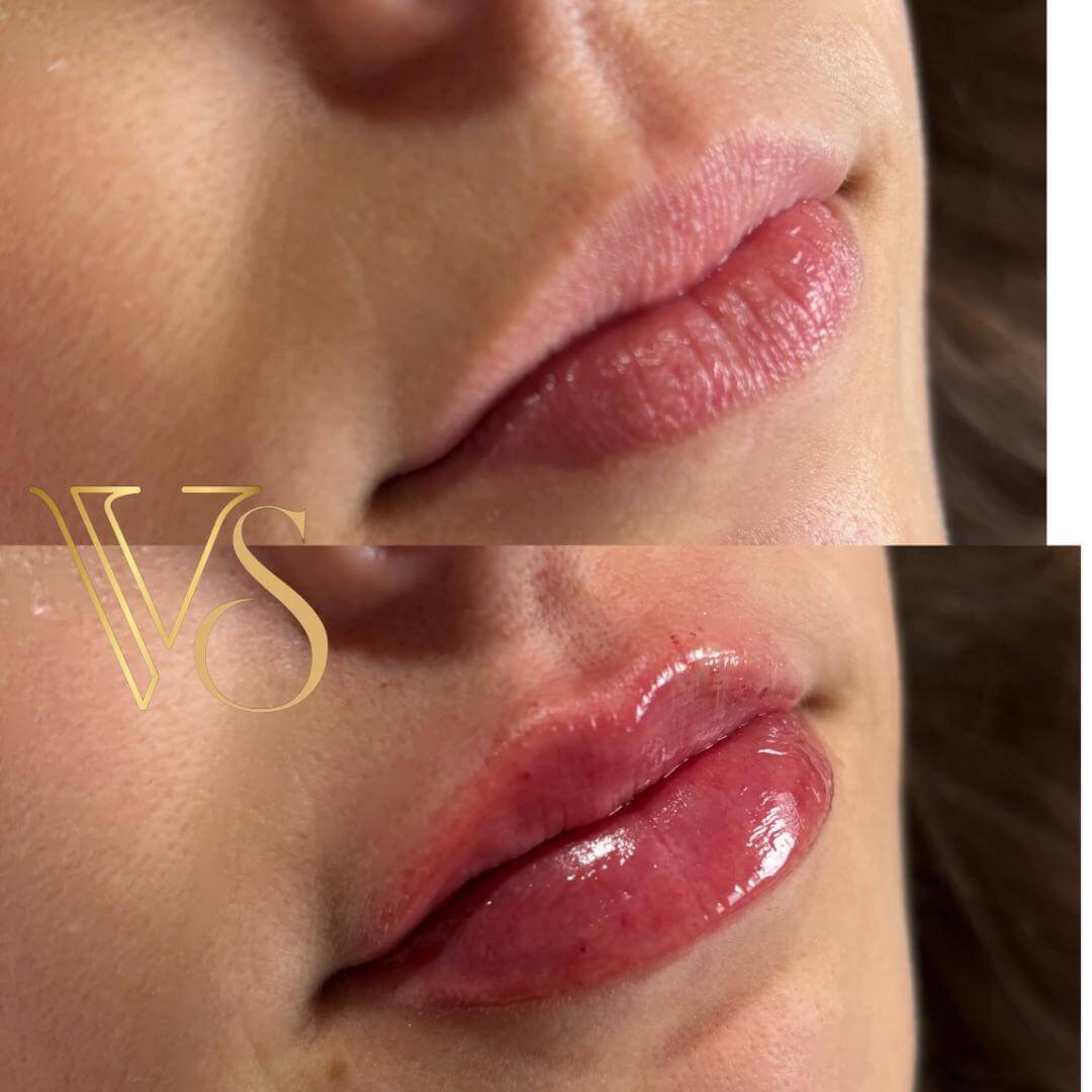 Referencia em preenchimento labial em Castro e Ponta Grossa - Dra Vanessa Silveira