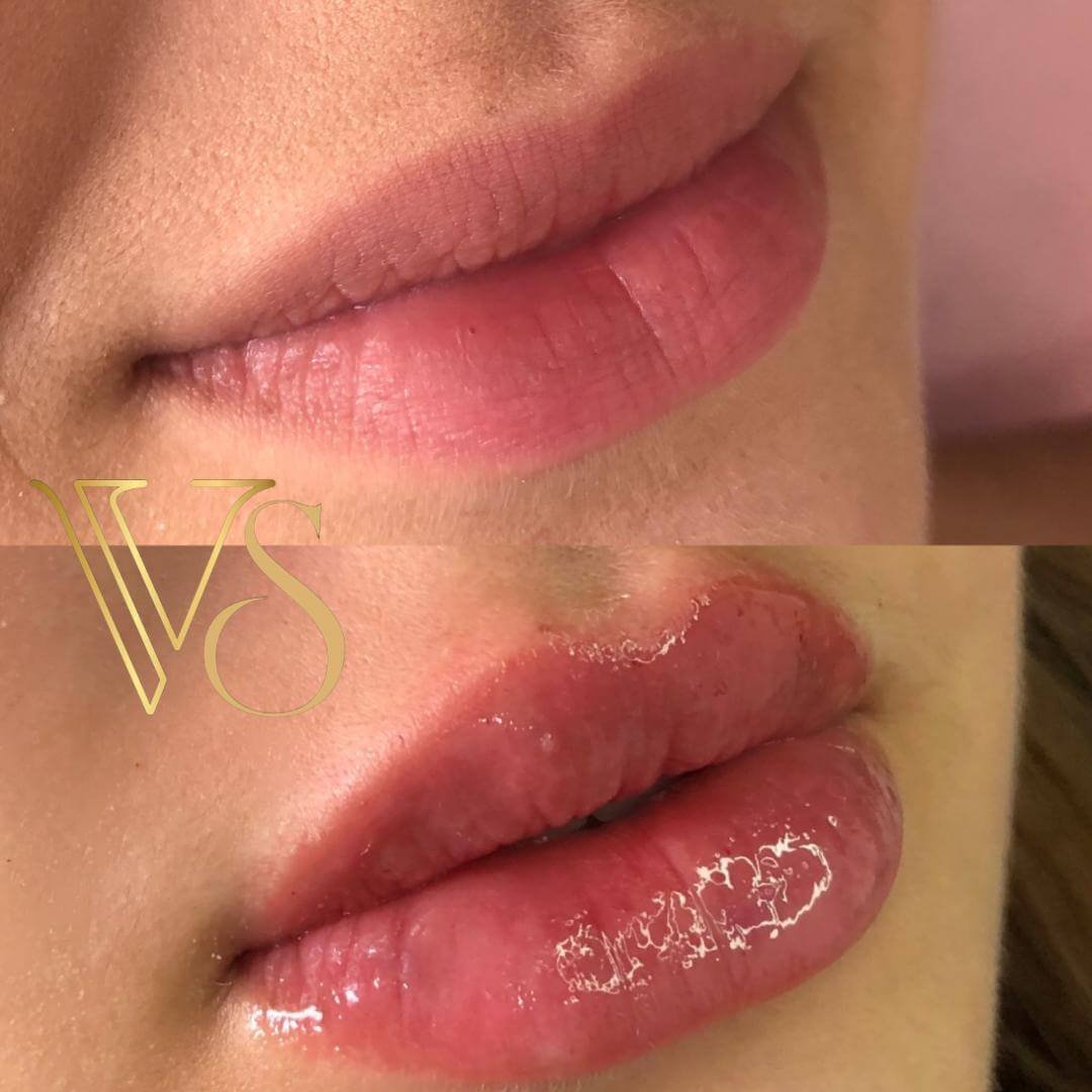 Referencia em preenchimento labial em Castro e Ponta Grossa - Dra Vanessa Silveira injetáveis de alta performance.