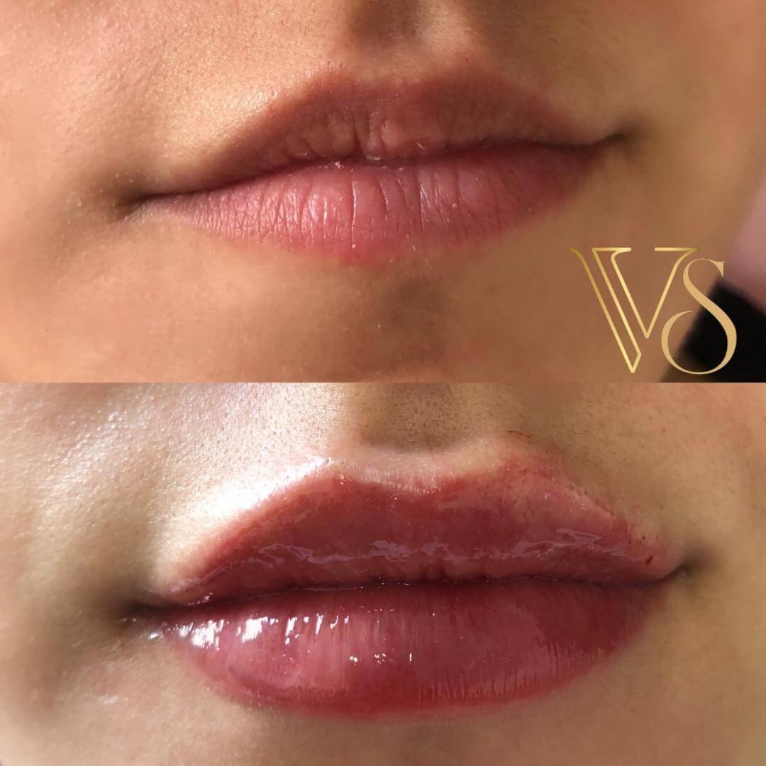 Referencia em preenchimento labial em Castro e Ponta Grossa - Dra Vanessa Silveira