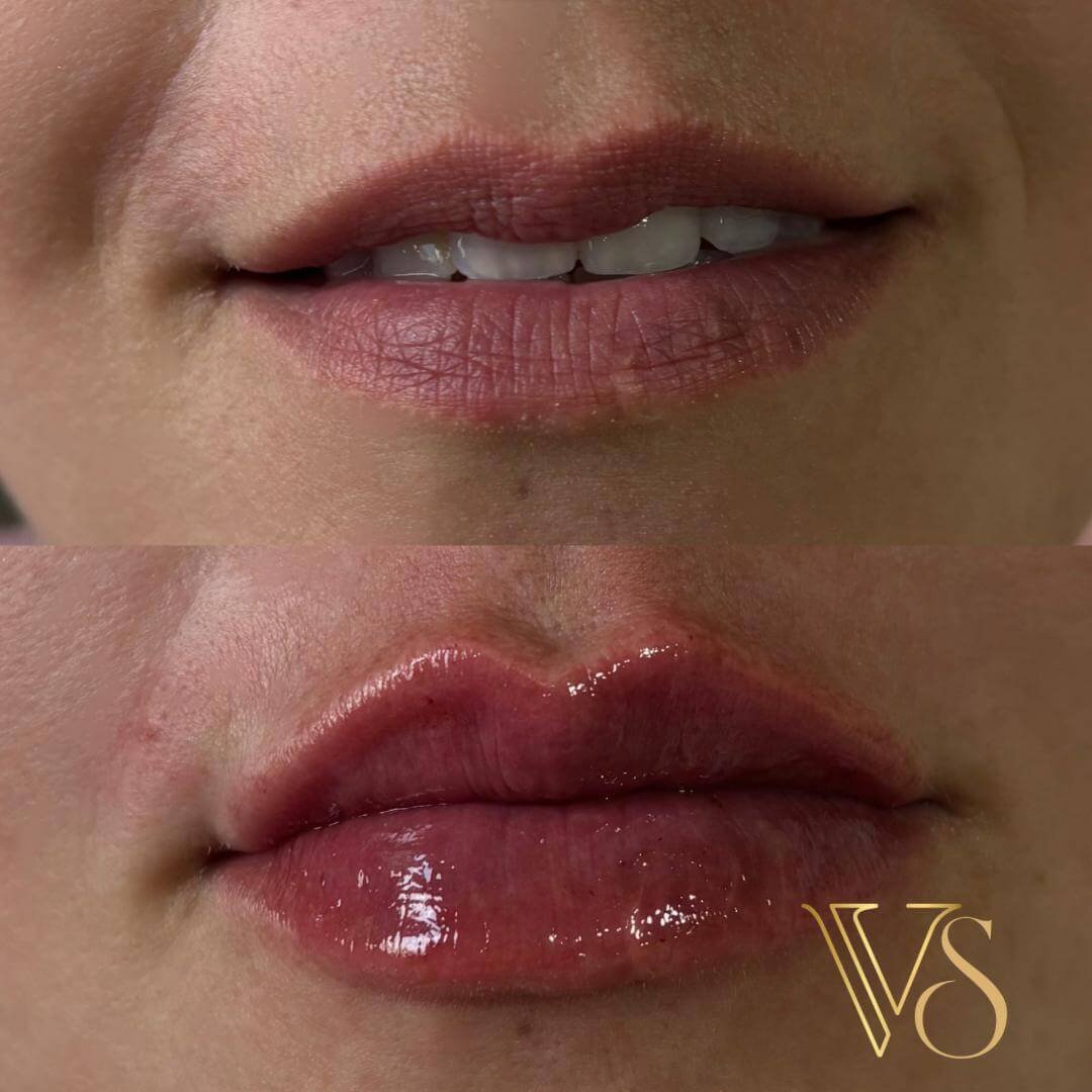 Referencia em preenchimento labial em Castro e Ponta Grossa - Dra Vanessa Silveira