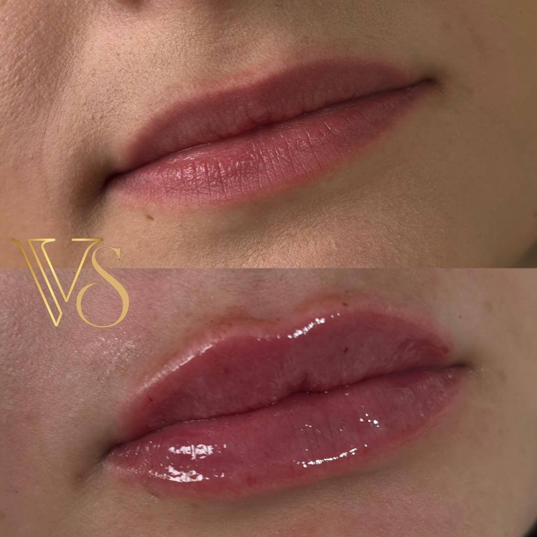 Referencia em preenchimento labial em Castro e Ponta Grossa - Dra Vanessa Silveira