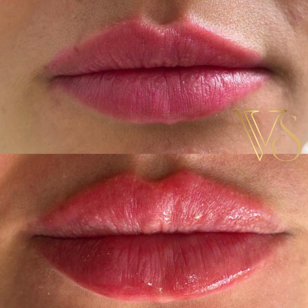 Preenchimento labial para volume refinado e projeção do arco do cupido com injetáveis de alta performance.