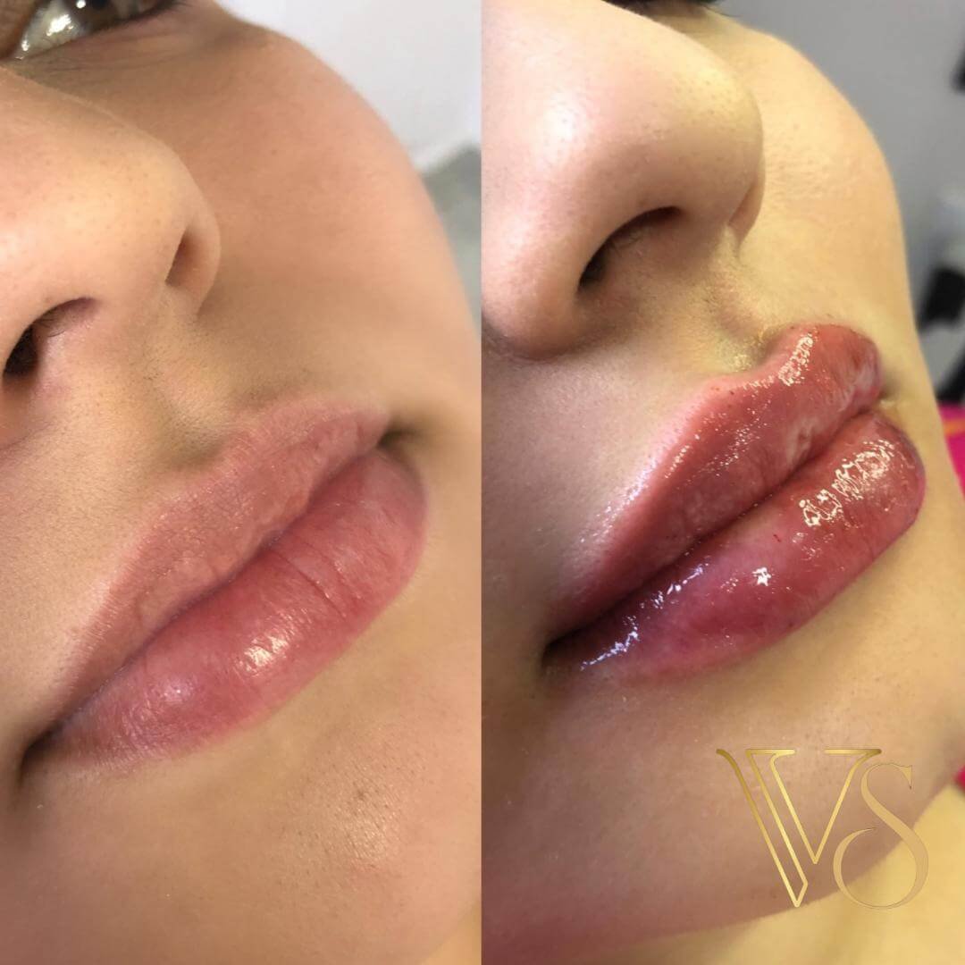 Preenchimento labial para volume refinado e projeção do arco do cupido com injetáveis de alta performance. Dra Vanessa
