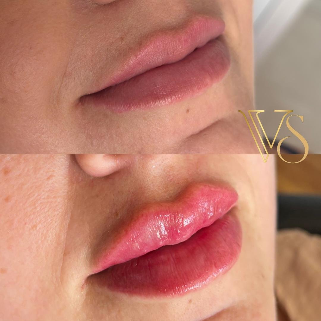 Referencia em preenchimento labial em Castro e Ponta Grossa - Dra Vanessa Silveira