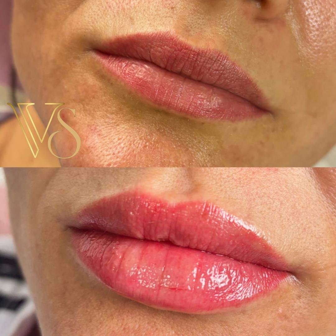 Preenchimento labial com foco em naturalidade e hidratação profunda seguindo o conceito Quiet Beauty - Dra. Vanessa Silveira.