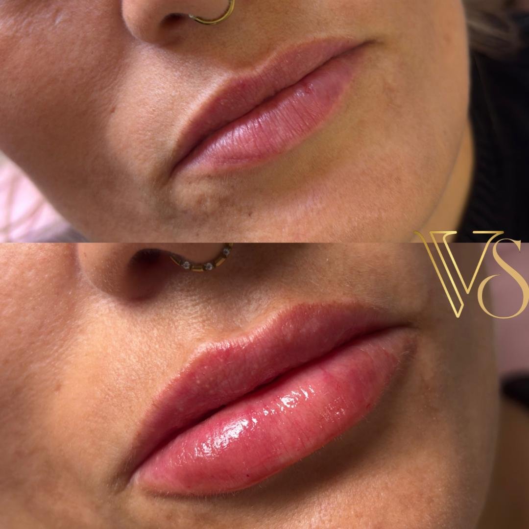Preenchimento labial com foco em naturalidade e hidratação profunda seguindo o conceito Quiet Beauty - Dra. Vanessa Silveira.