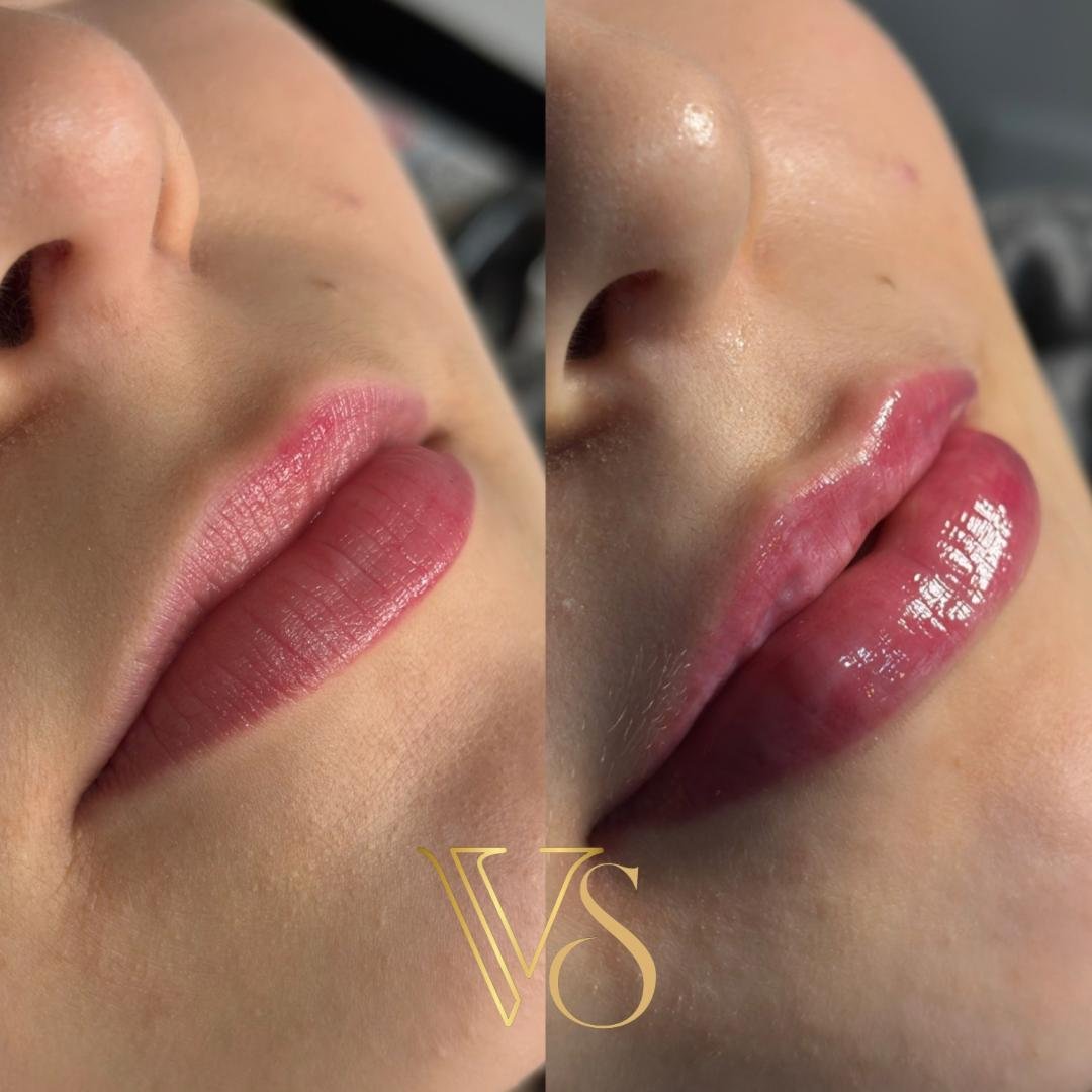 Referencia em arco do cupido bem desenhado - Dra Vanessa Silveira em Castro e Ponta Grossa