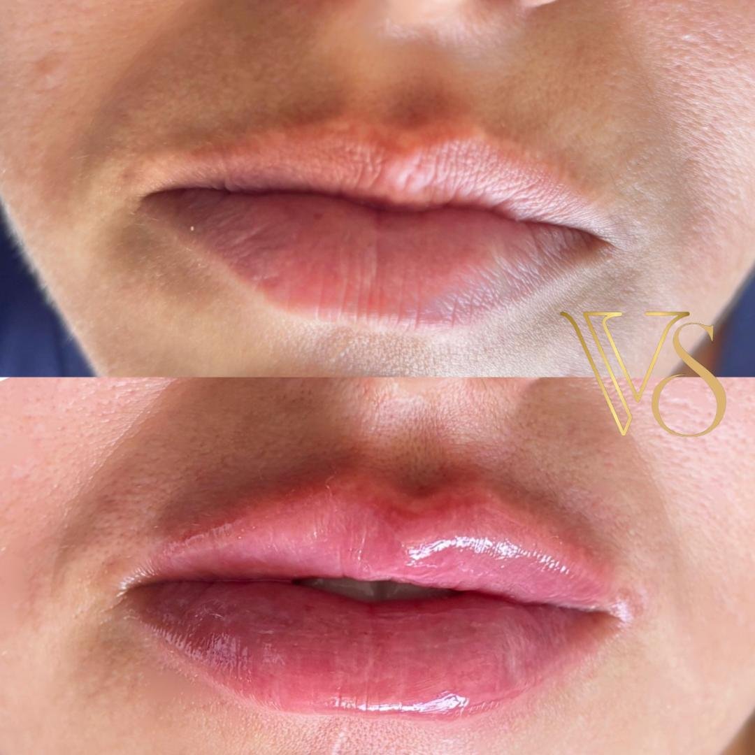 Preenchimento labial com foco em naturalidade e hidratação profunda seguindo o conceito Quiet Beauty - Dra. Vanessa Silveira.