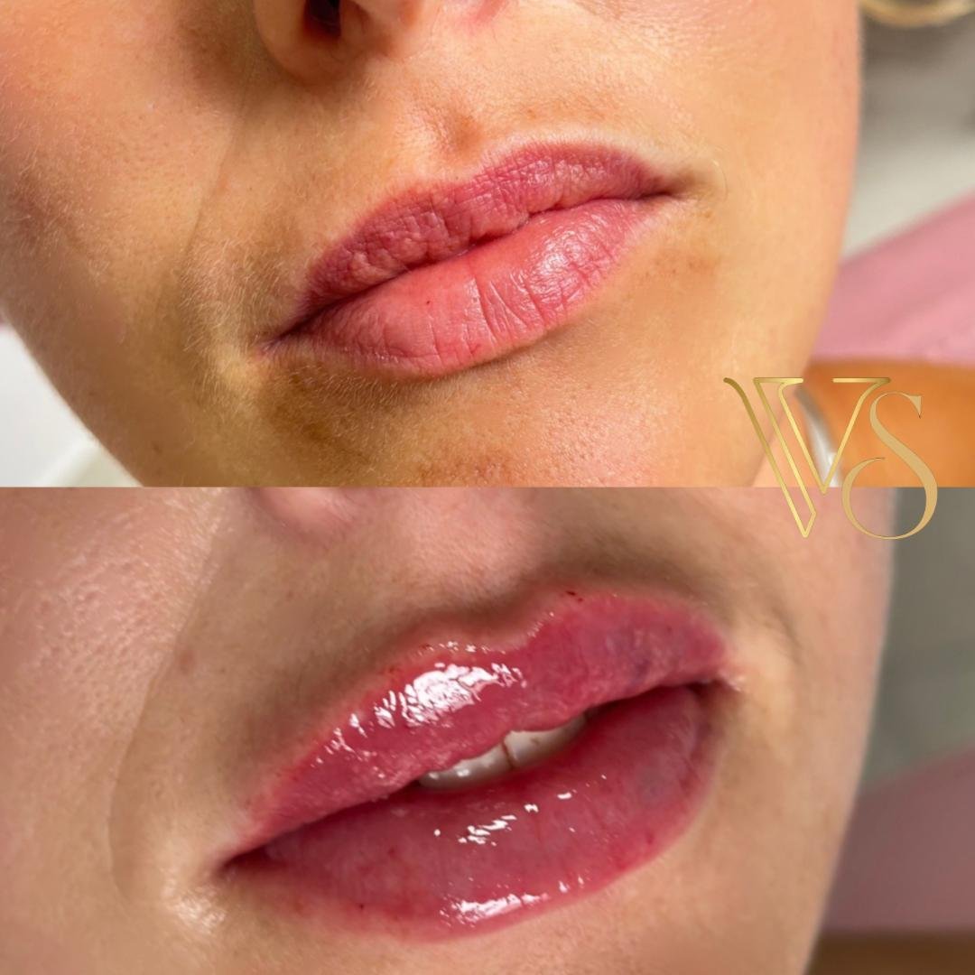 Preenchimento labial com foco em naturalidade e hidratação profunda seguindo o conceito Quiet Beauty - Dra. Vanessa Silveira.