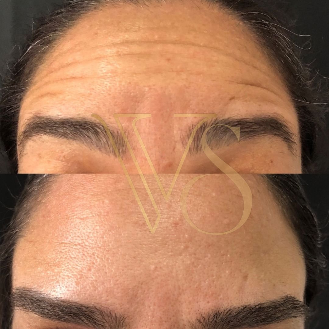 Botox em Castro Dra Vanessa Silveira