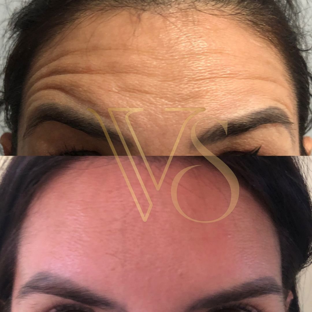 Botox em Castro Dra Vanessa Silveira