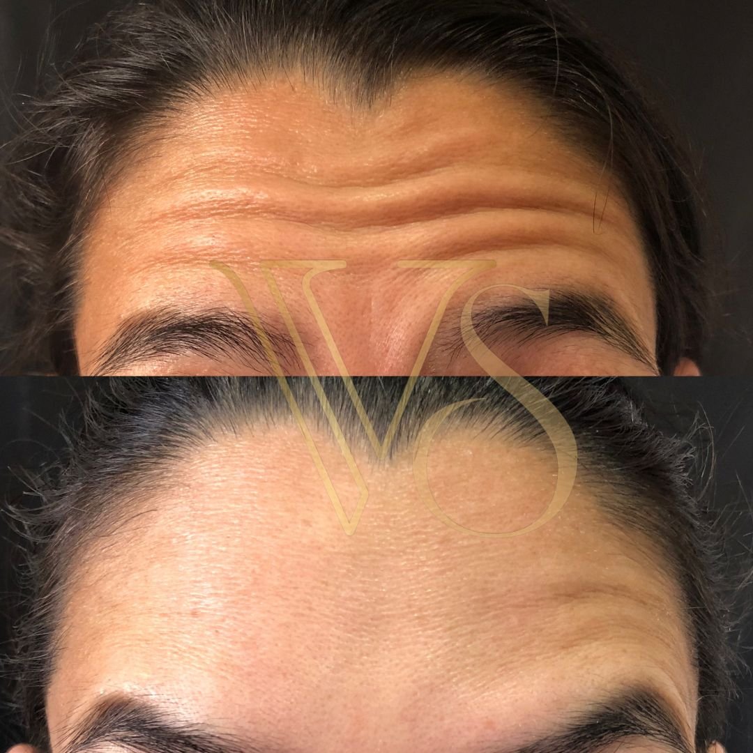 Botox em Castro Dra Vanessa Silveira