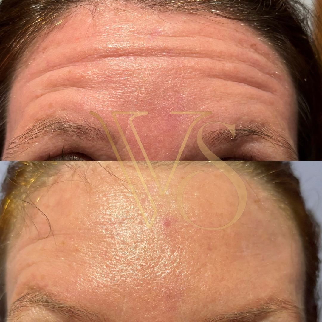 Botox em Castro Dra Vanessa Silveira