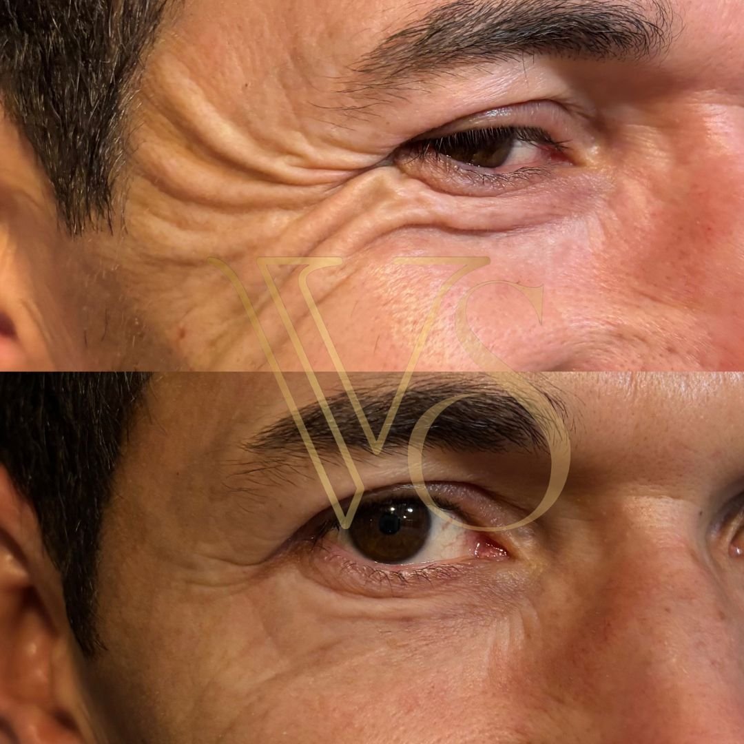 Botox masculino em Castro e Ponta Grossa Dra Vanessa Silveira