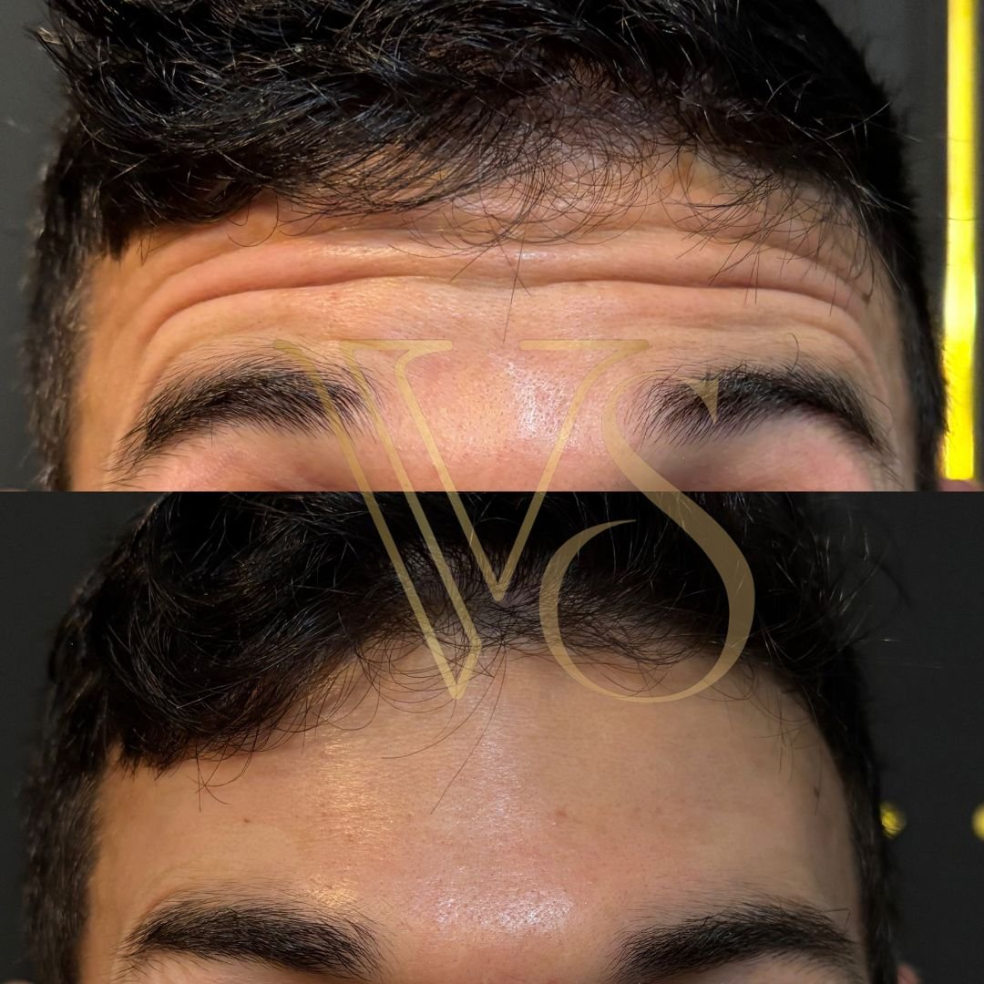 Botox masculino em Castro e Ponta Grossa - Dra Vanessa Silveira