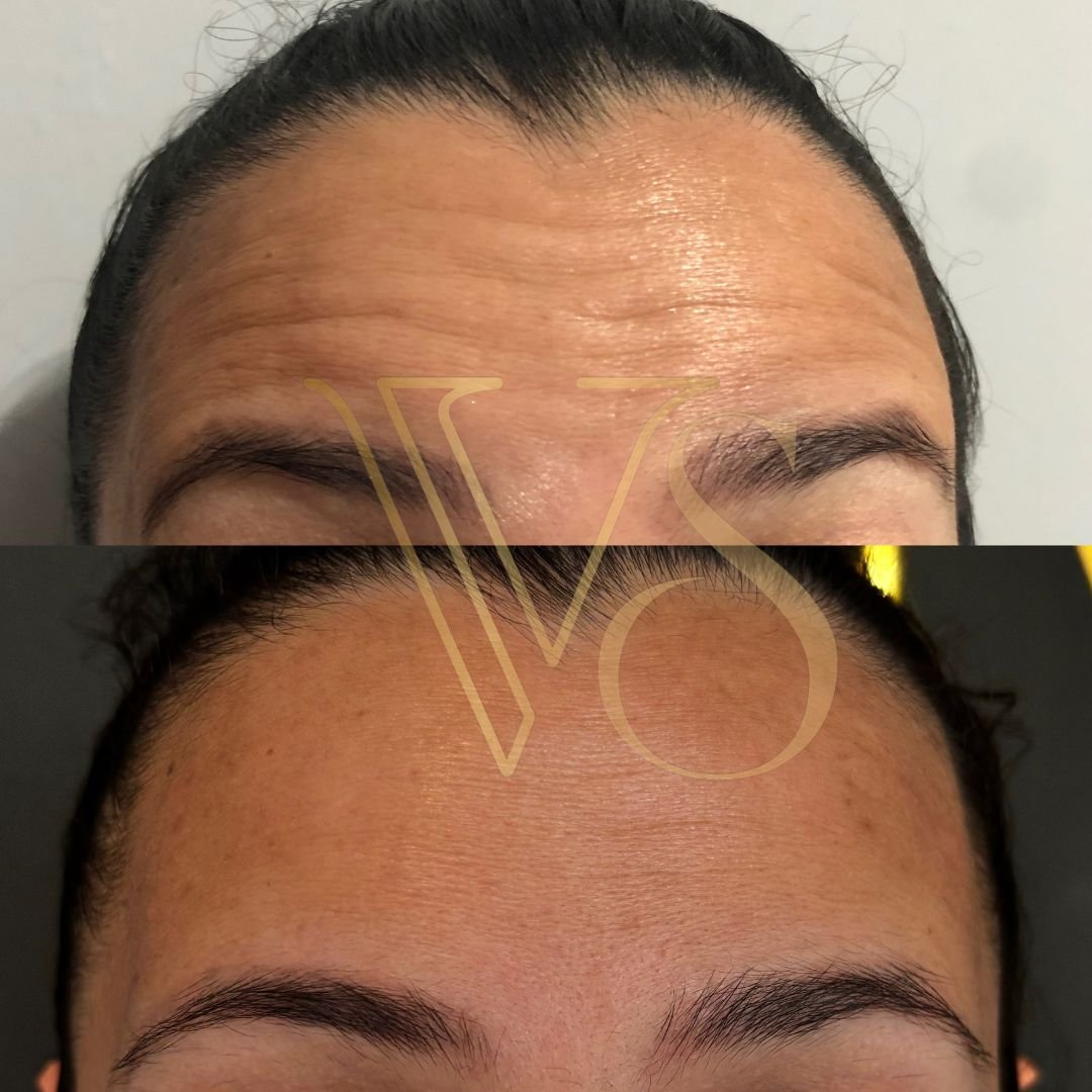 Botox em Castro Dra Vanessa Silveira
