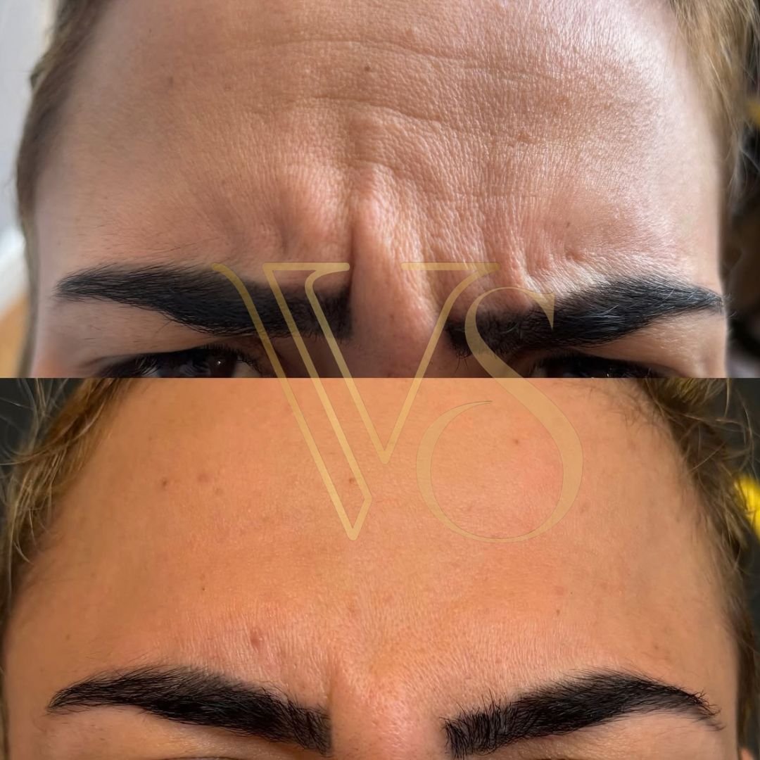 Botox em Castro e Ponta Grossa - Dra Vanessa Silveira