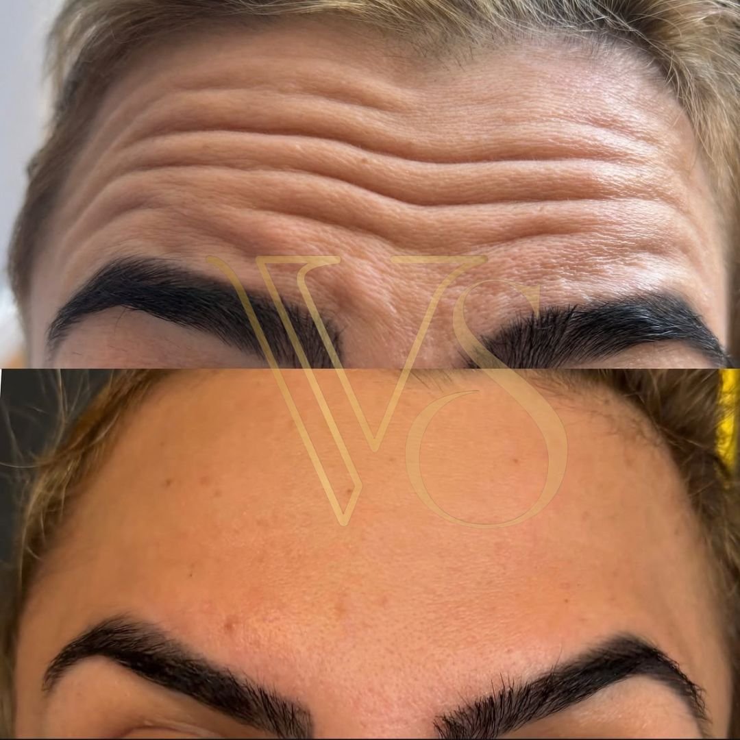 Botox em Castro Dra Vanessa Silveira