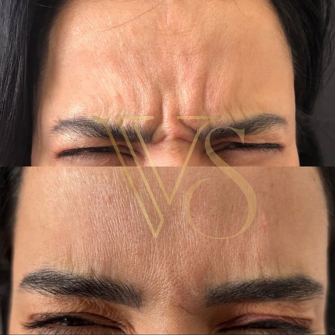 Botox em Castro Dra Vanessa Silveira