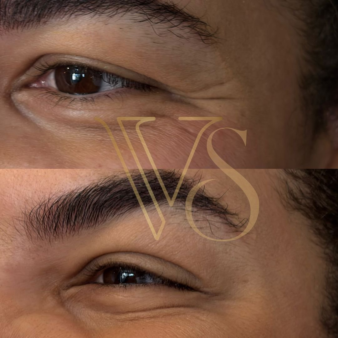 Botox em Castro e Ponta Grossa - Dra Vanessa Silveira