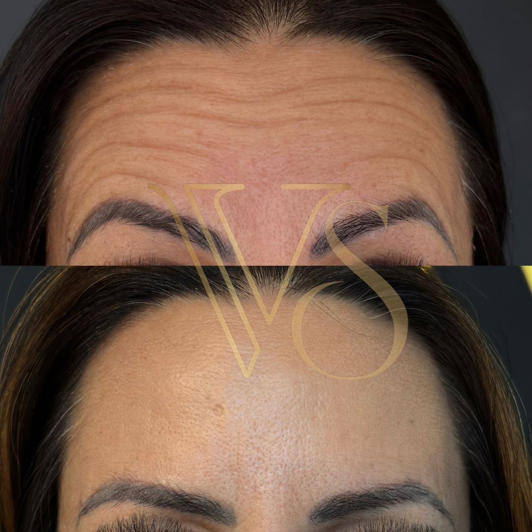 Botox em Castro e Ponta Grossa - Dra Vanessa Silveira