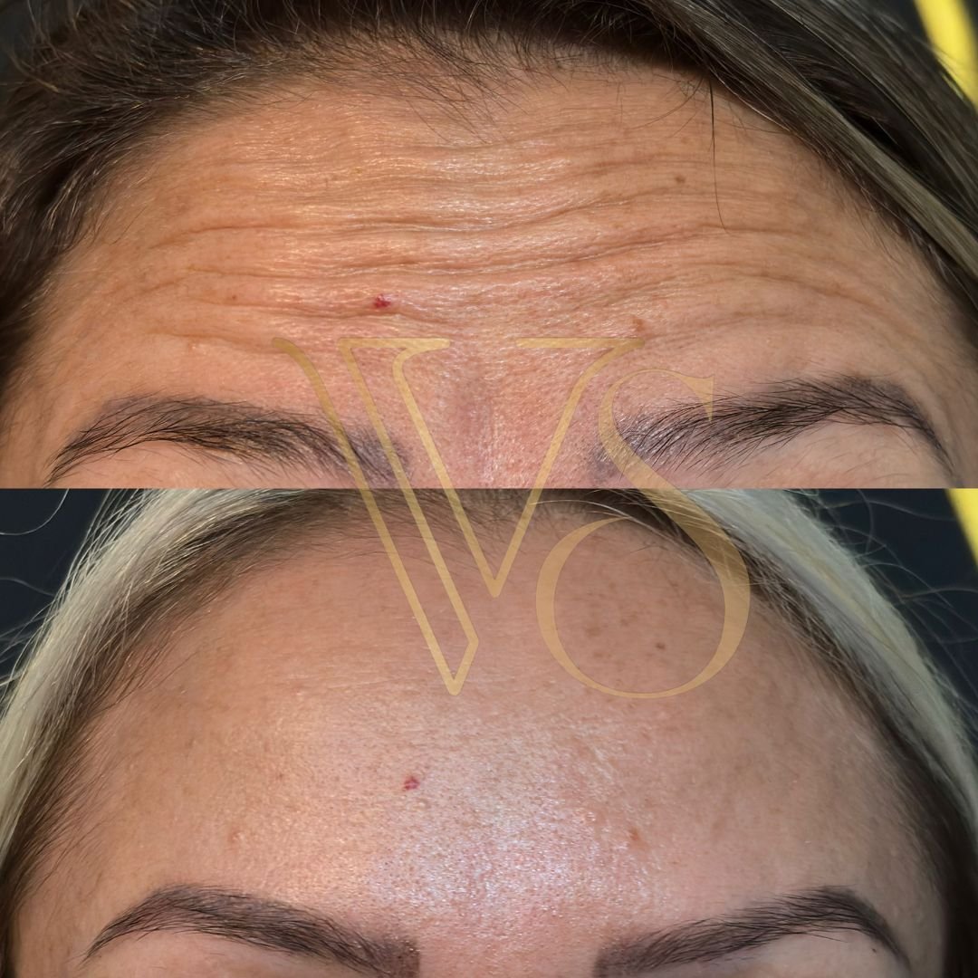 Botox em Castro Dra Vanessa Silveira