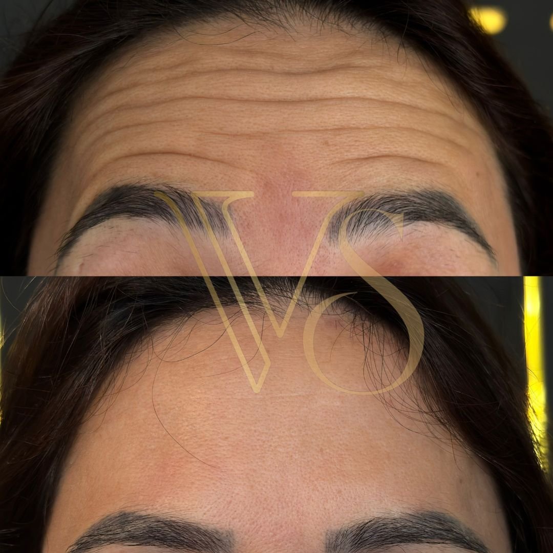 Botox em Castro Dra Vanessa Silveira