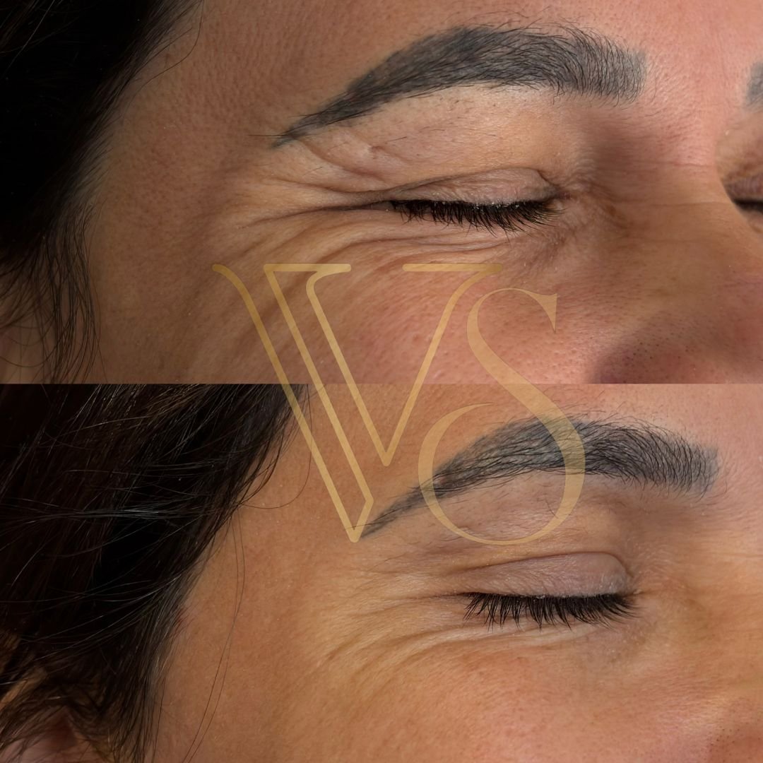 Botox em Castro e Ponta Grossa - Dra Vanessa Silveira