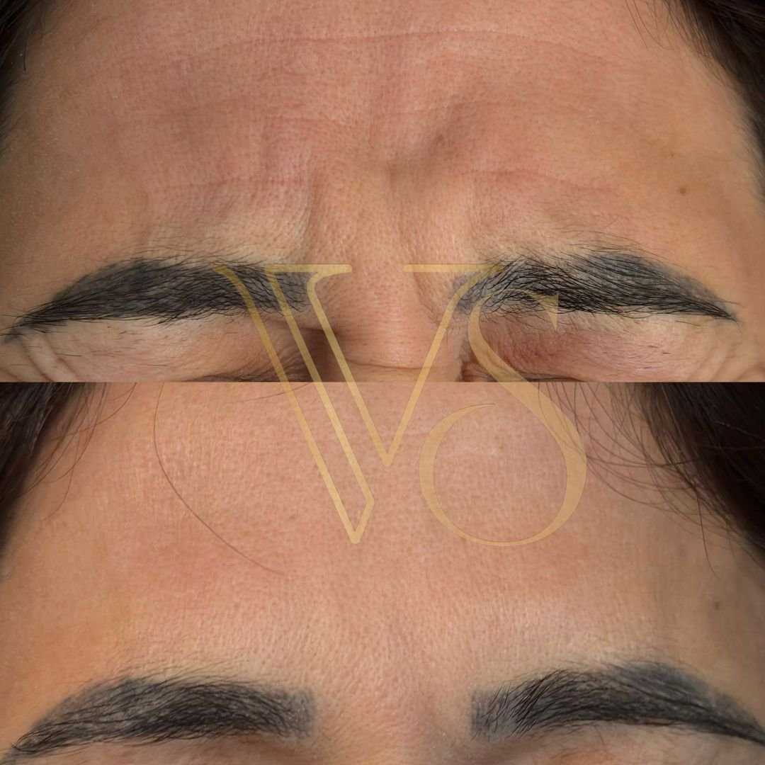 Botox em Castro Dra Vanessa Silveira