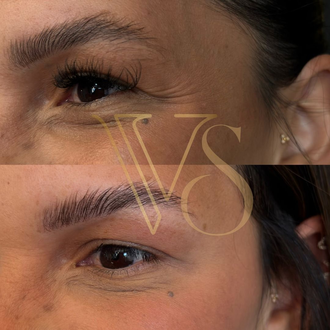 Botox em Castro e Ponta Grossa - Dra Vanessa Silveira