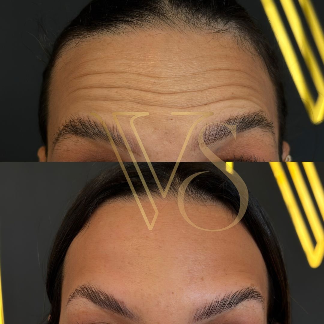 Botox em Castro e Ponta Grossa - Dra Vanessa Silveira