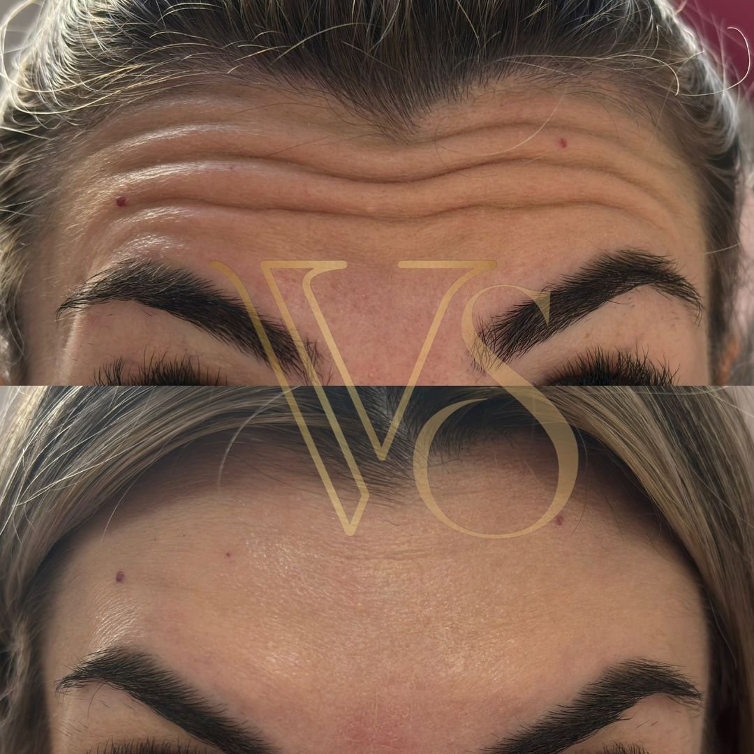 Botox em Castro e Ponta Grossa - Dra Vanessa Silveira