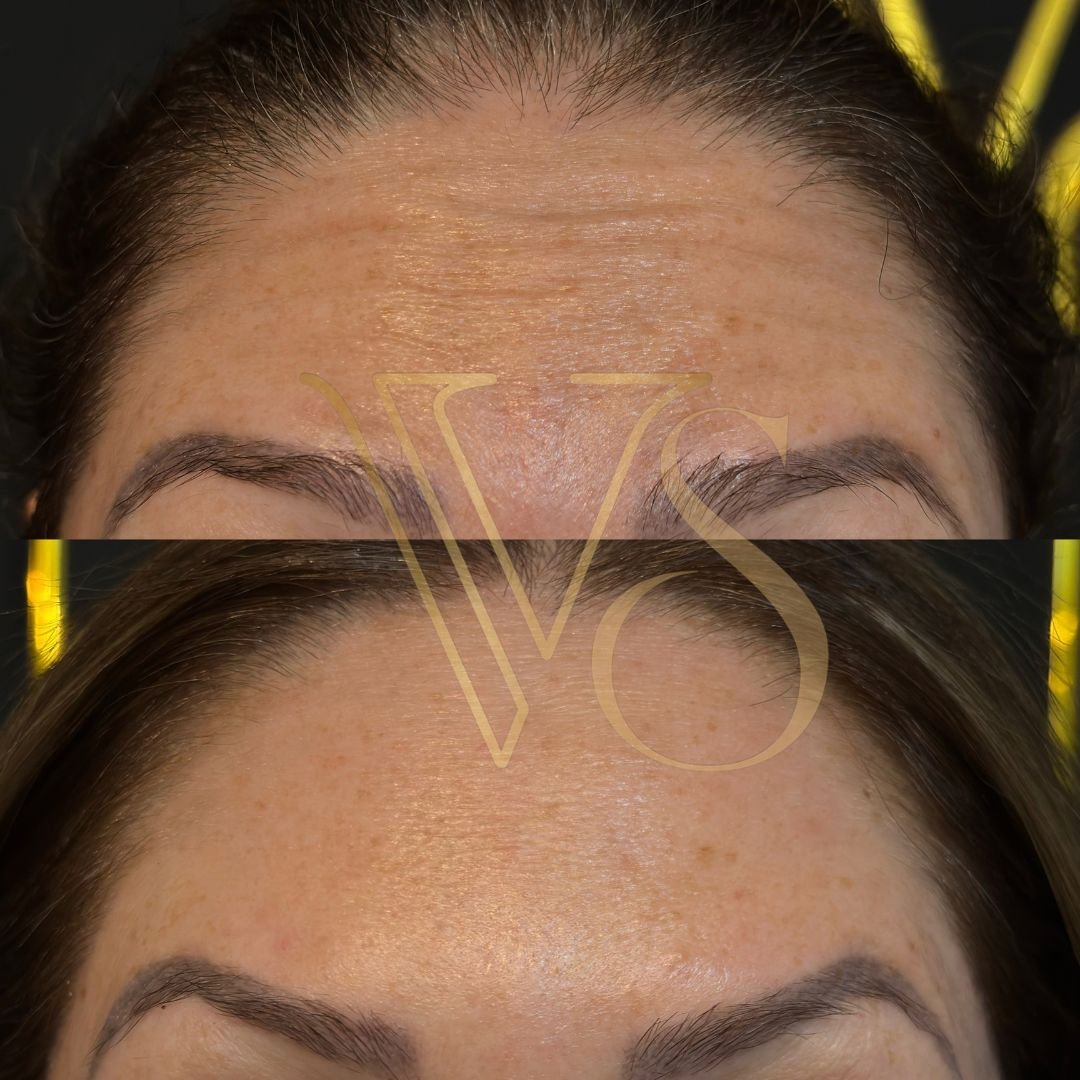 Botox em Castro e Ponta Grossa - Dra Vanessa Silveira