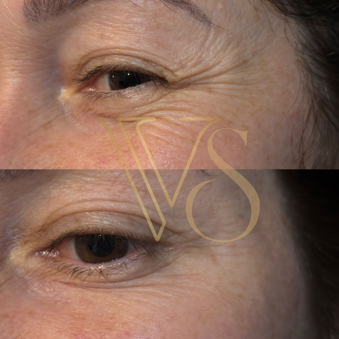 Botox em Castro e Ponta Grossa - Dra Vanessa Silveira