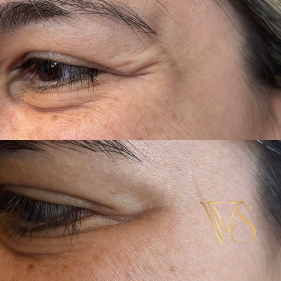 Botox em Castro e Ponta Grossa - Dra Vanessa Silveira