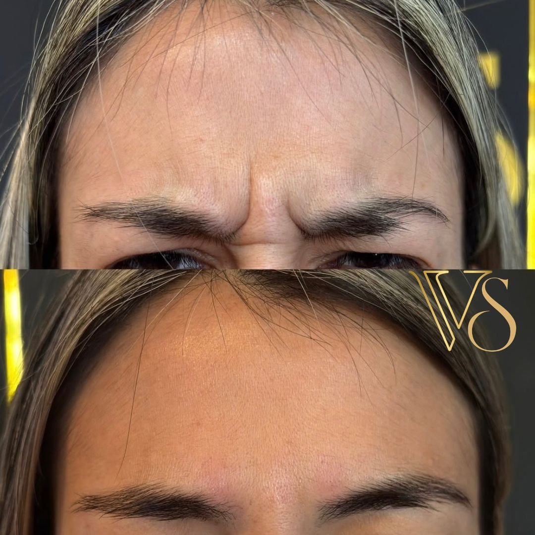 Botox em Castro e Ponta Grossa - Dra Vanessa Silveira