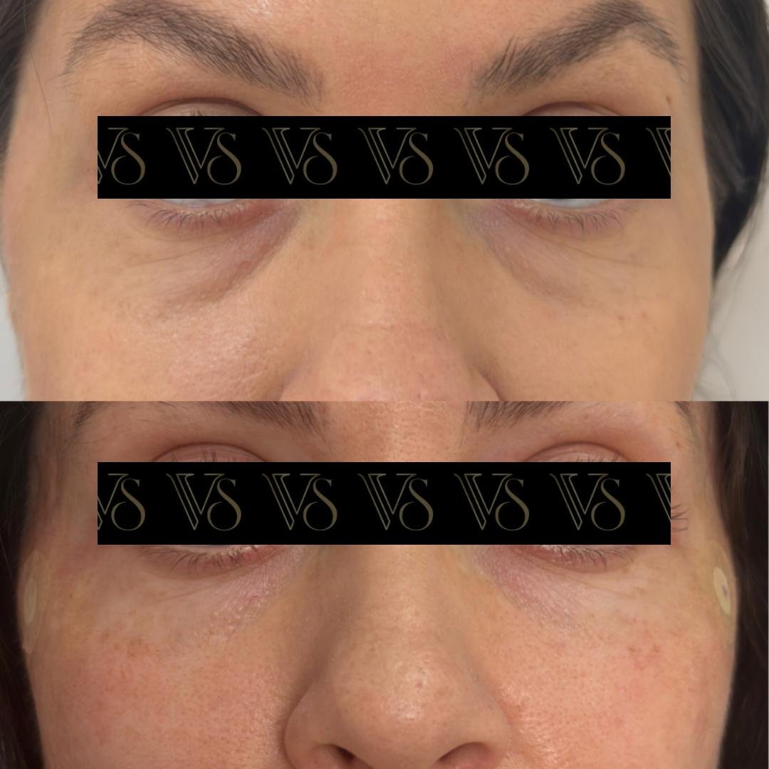 Preenchimento de olheiras, olhar renovado conceito Quiet Beauty em Castro - Dra