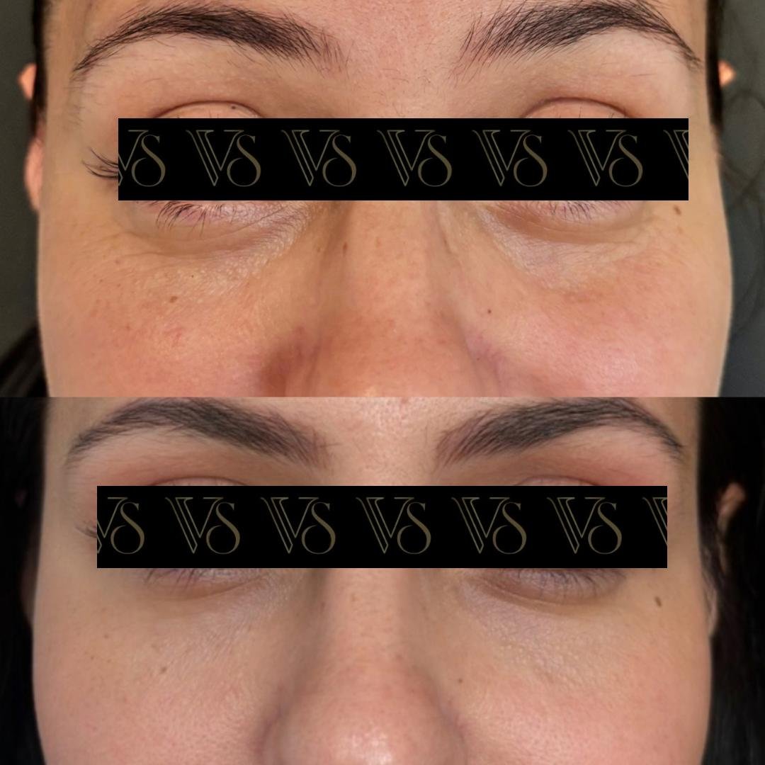 Preenchimento de olheiras, olhar renovado conceito Quiet Beauty em Castro - Dra Vanessa Silveira