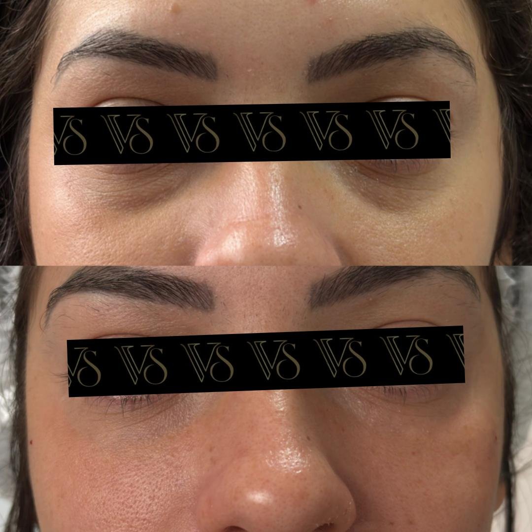 Preenchimento de olheiras, olhar renovado conceito Quiet Beauty em Castro - Dra Vanessa Silveira