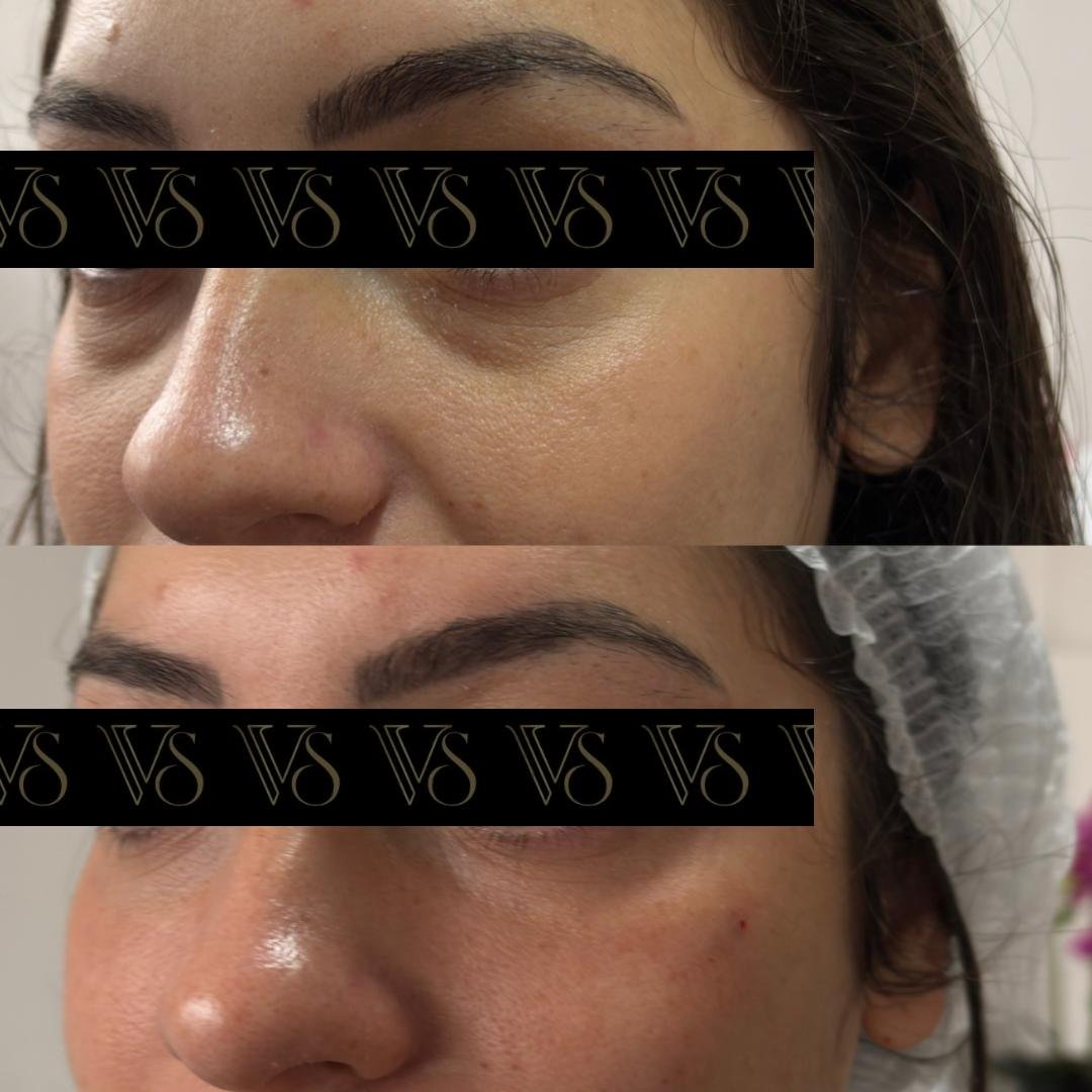 Preenchimento de olheiras, olhar renovado conceito Quiet Beauty em Castro e Ponta Grossa - Dra Vanessa Silveira