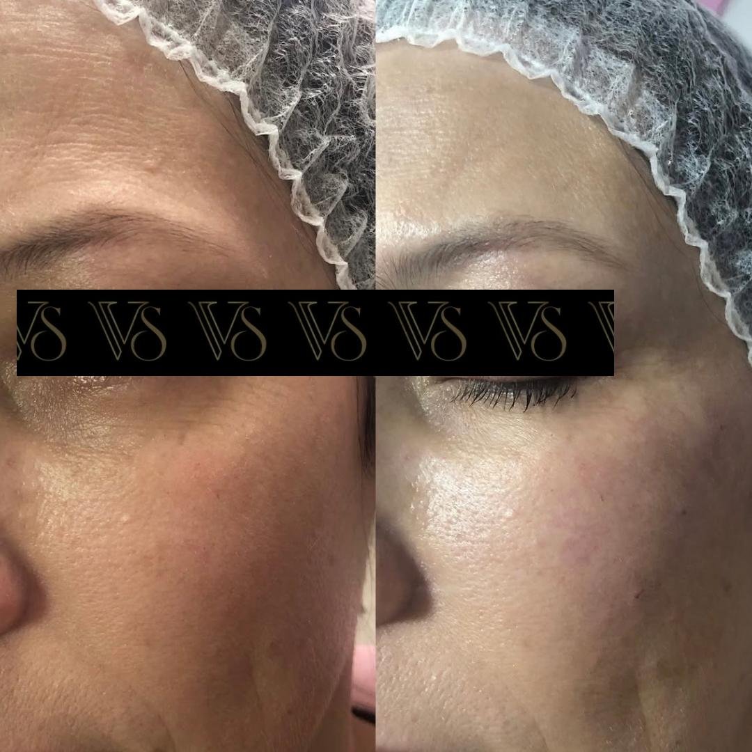 Preenchimento de olheiras, olhar renovado conceito Quiet Beauty em Castro - Dra Preenchimento de olheiras, olhar renovado conceito Quiet Beauty em Castro - Dra Vanessa Silveira