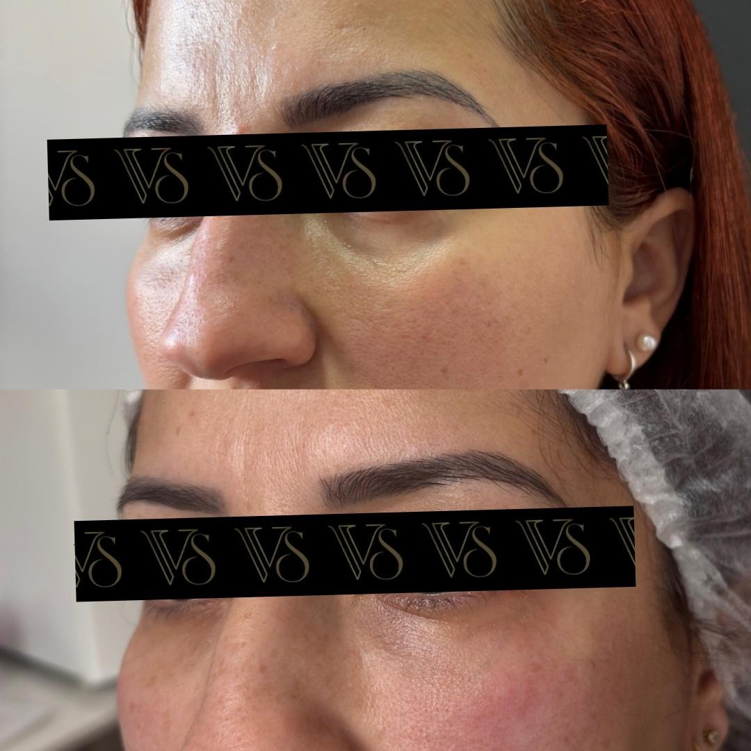 Preenchimento de olheiras, olhar renovado conceito Quiet Beauty em Castro - Dra Vanessa Silveira