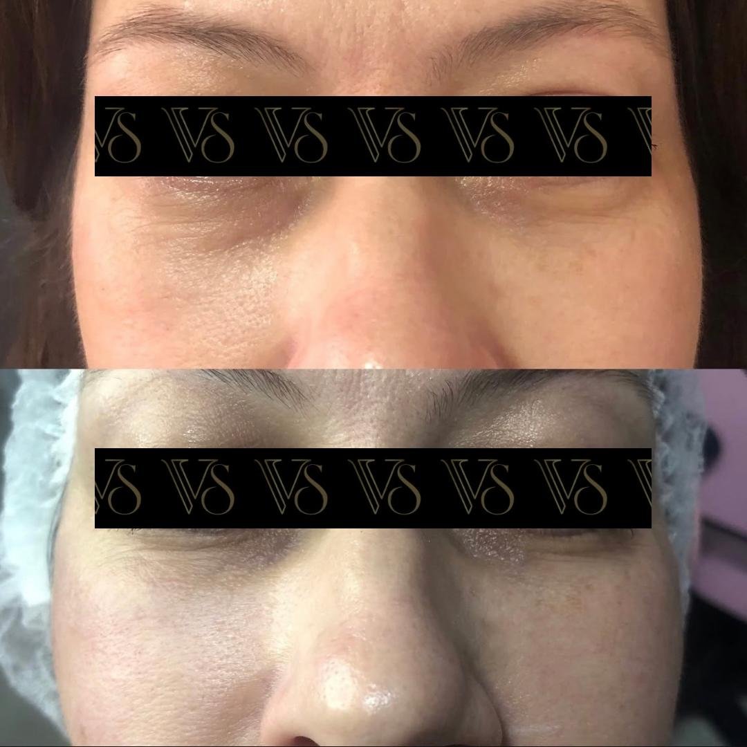 Preenchimento de olheiras, olhar renovado conceito Quiet Beauty em Castro - Dra Vanessa Silveira