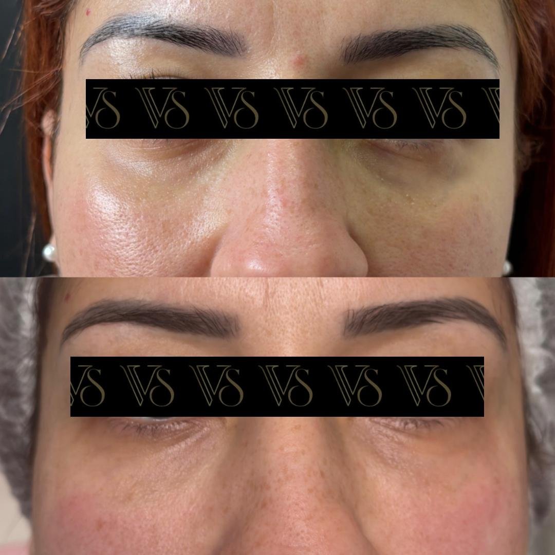 Preenchimento de olheiras, olhar renovado conceito Quiet Beauty em Castro - Dra Vanessa Silveira