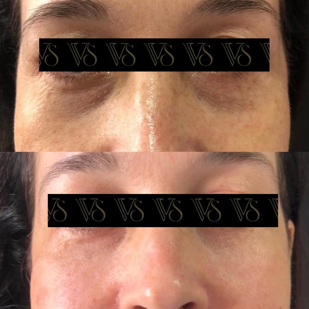 Preenchimento de olheiras, olhar renovado conceito Quiet Beauty em Castro - Dra Vanessa Silveira