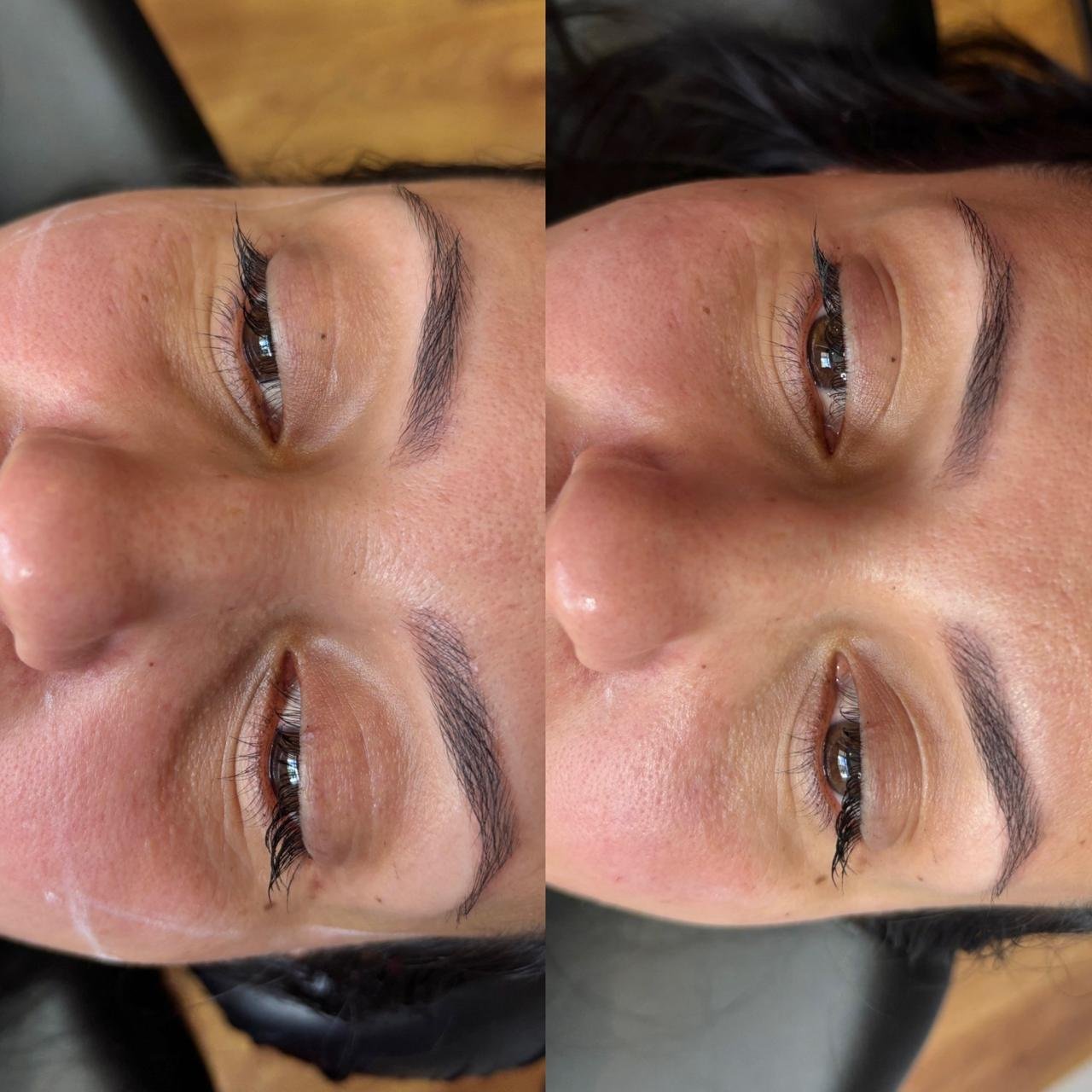 Preenchimento de olheiras natural Dra Vanessa Silveira Castro e Ponta Grossa