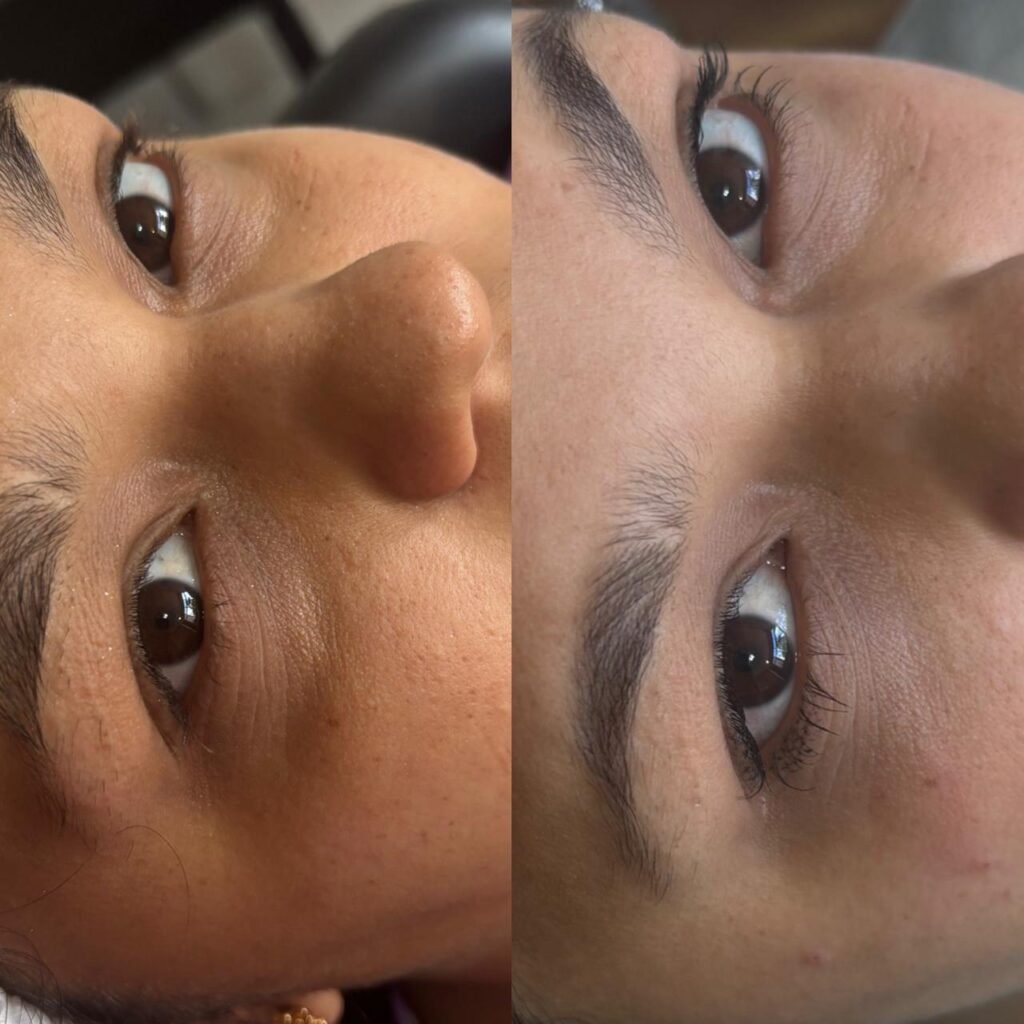 Preenchimento de olheiras em Castro-PR Dra Vanessa Silveira