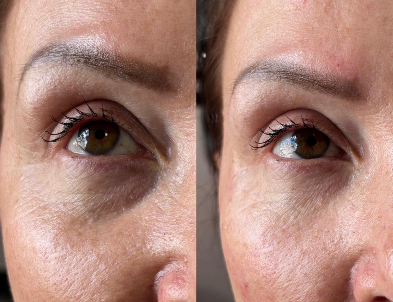 Preenchimento de olheiras, olhar renovado conceito Quiet Beauty em Castro - Dra Vanessa Silveira